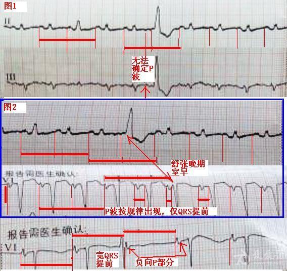 频发室早心电图图片