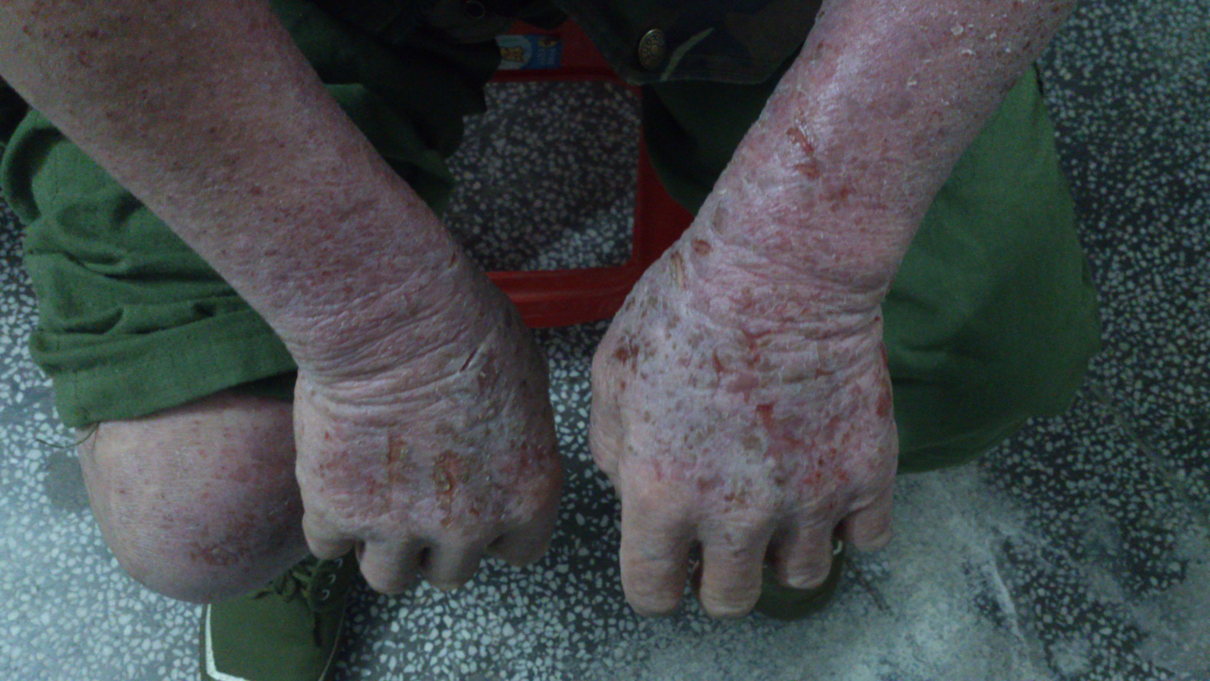 有请皮肤科专家看看这位大爷的皮肤病非常严重