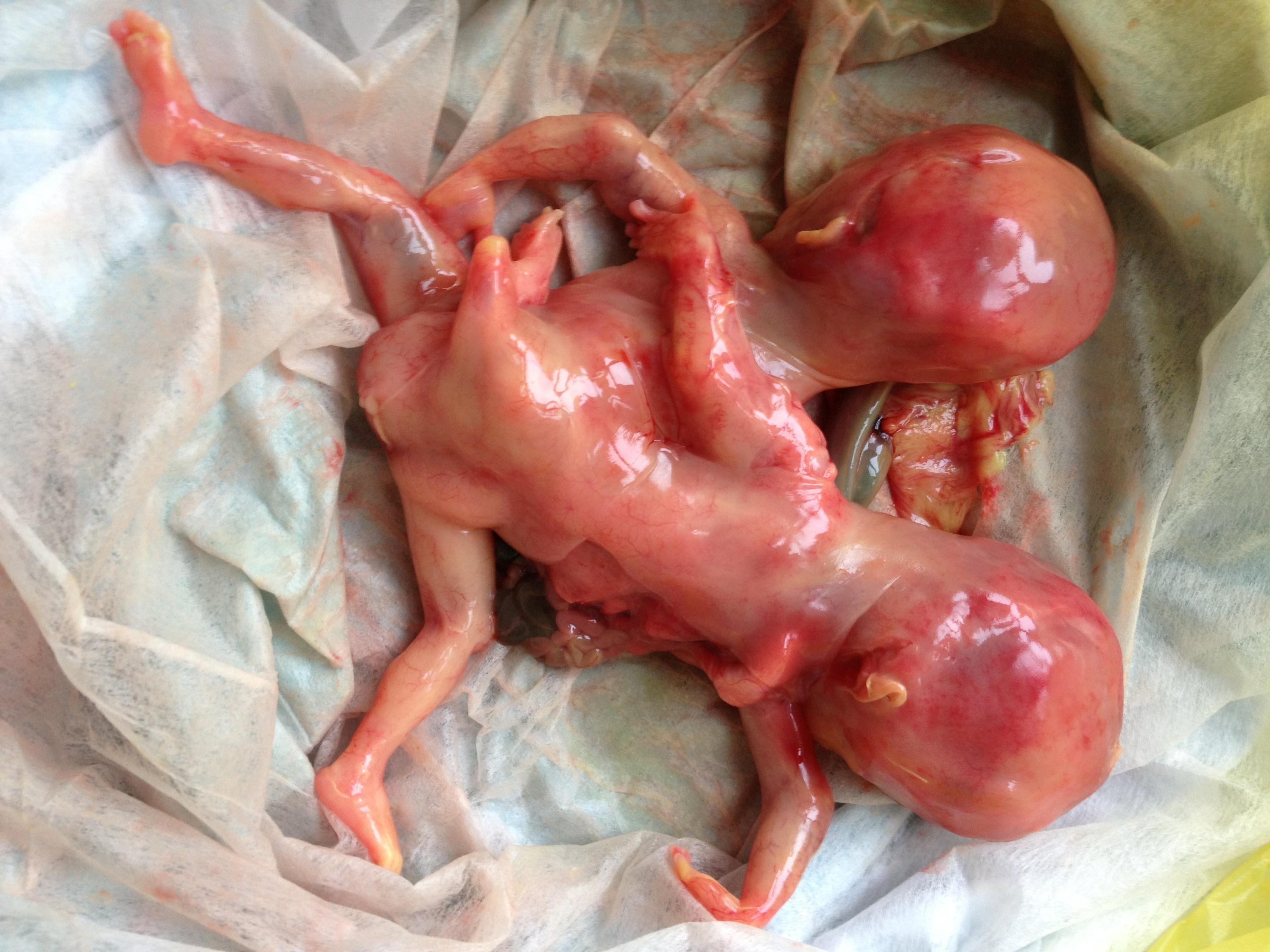 6个月引产的胎儿图片图片