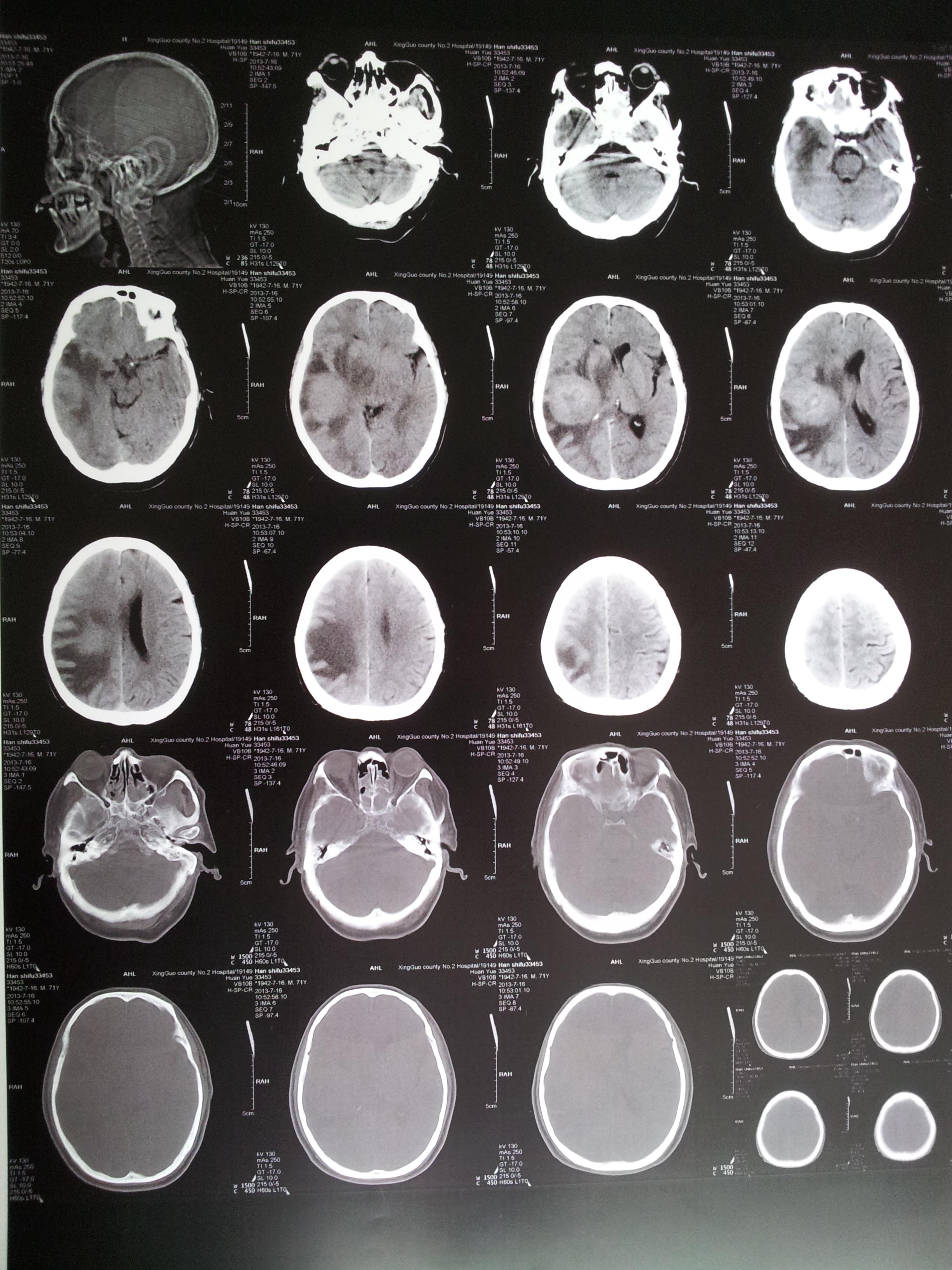 脑肿瘤片子图片