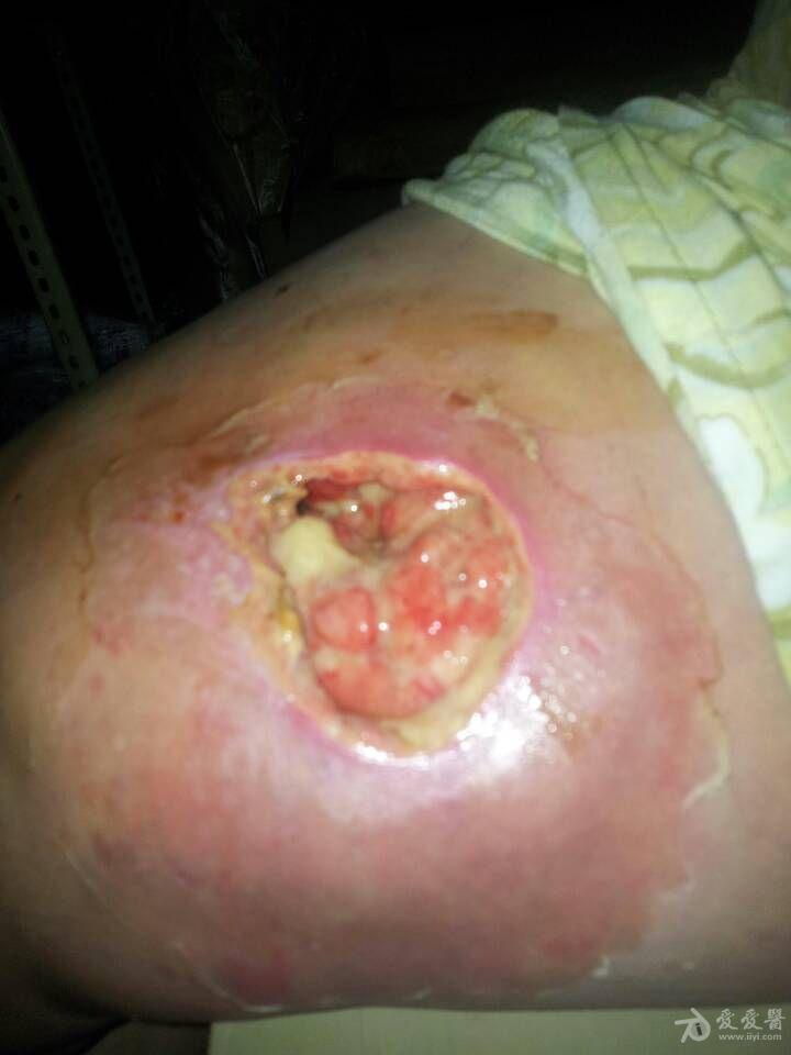 中药膏治疗撞伤后高度腐烂愈后图 - 中医皮肤版 - 爱爱医医学论坛