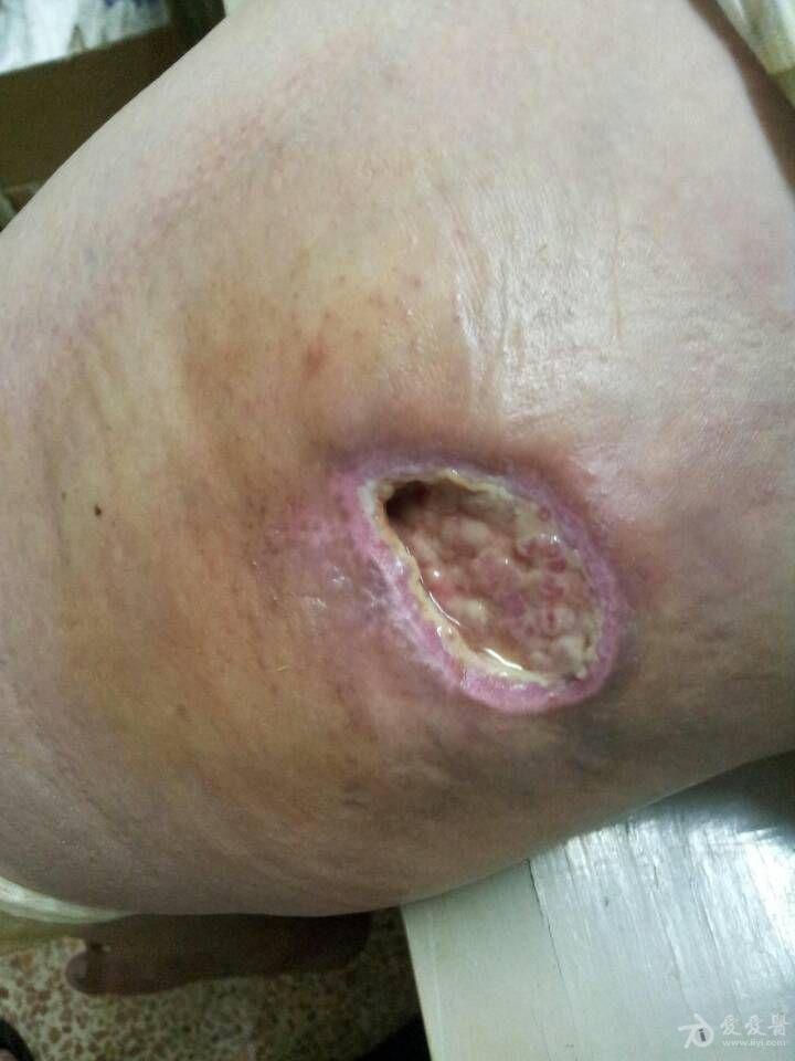 中药膏治疗撞伤后高度腐烂愈后图 - 中医皮肤版 - 爱爱医医学论坛
