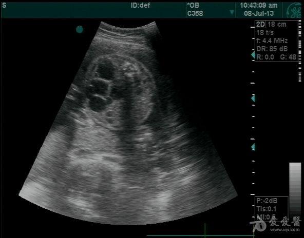 胎儿多囊肾不多说直接上图