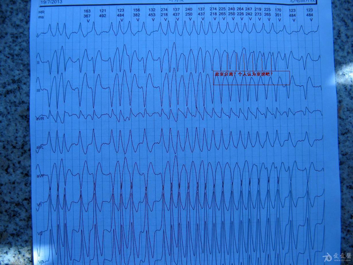 or房颤 室速 心电图脑电图专业讨论版 爱爱医医学论坛