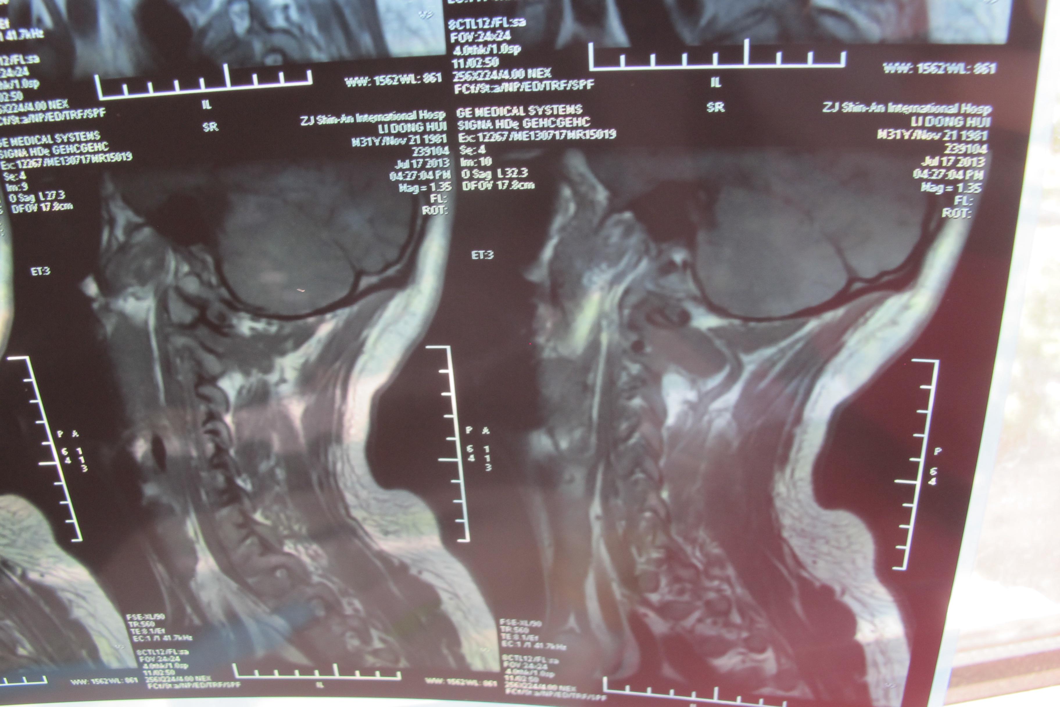 颈椎间盘轻度突出