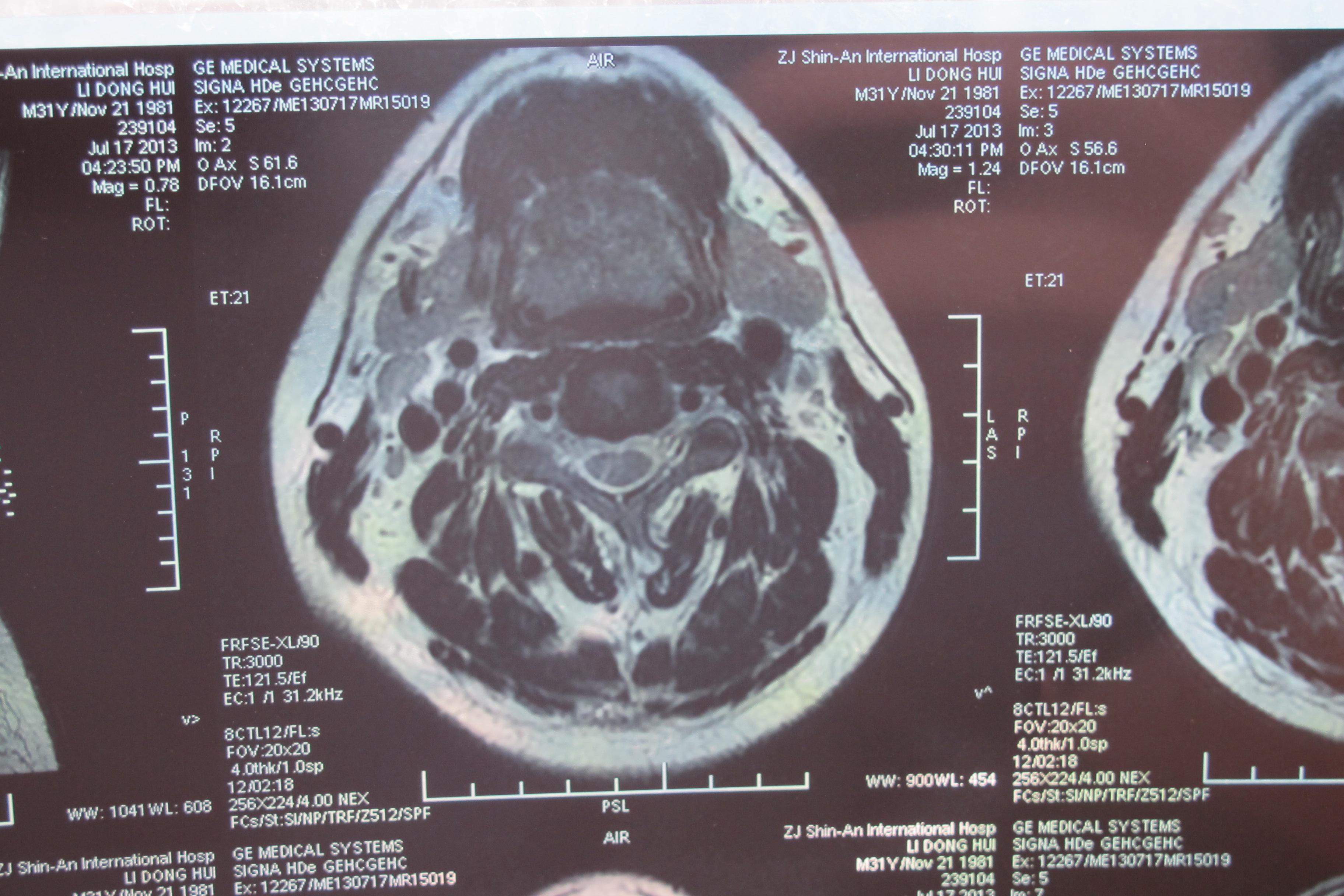 颈椎间盘轻度突出