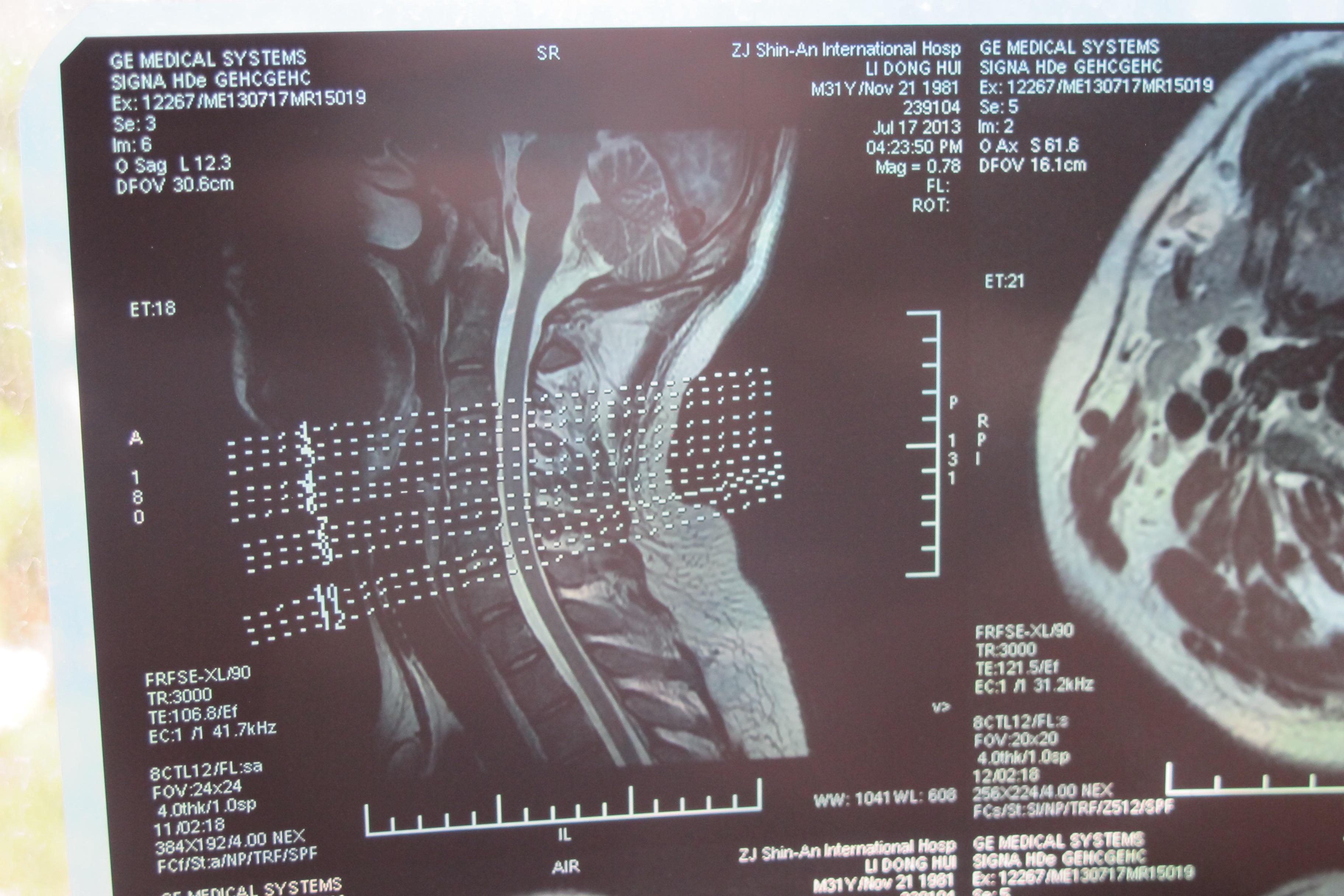 腰椎l5s1突出锻炼方法_腰椎间盘突出症的锻炼方法视频(流畅)_腰椎间盘突出症的功能锻炼方法