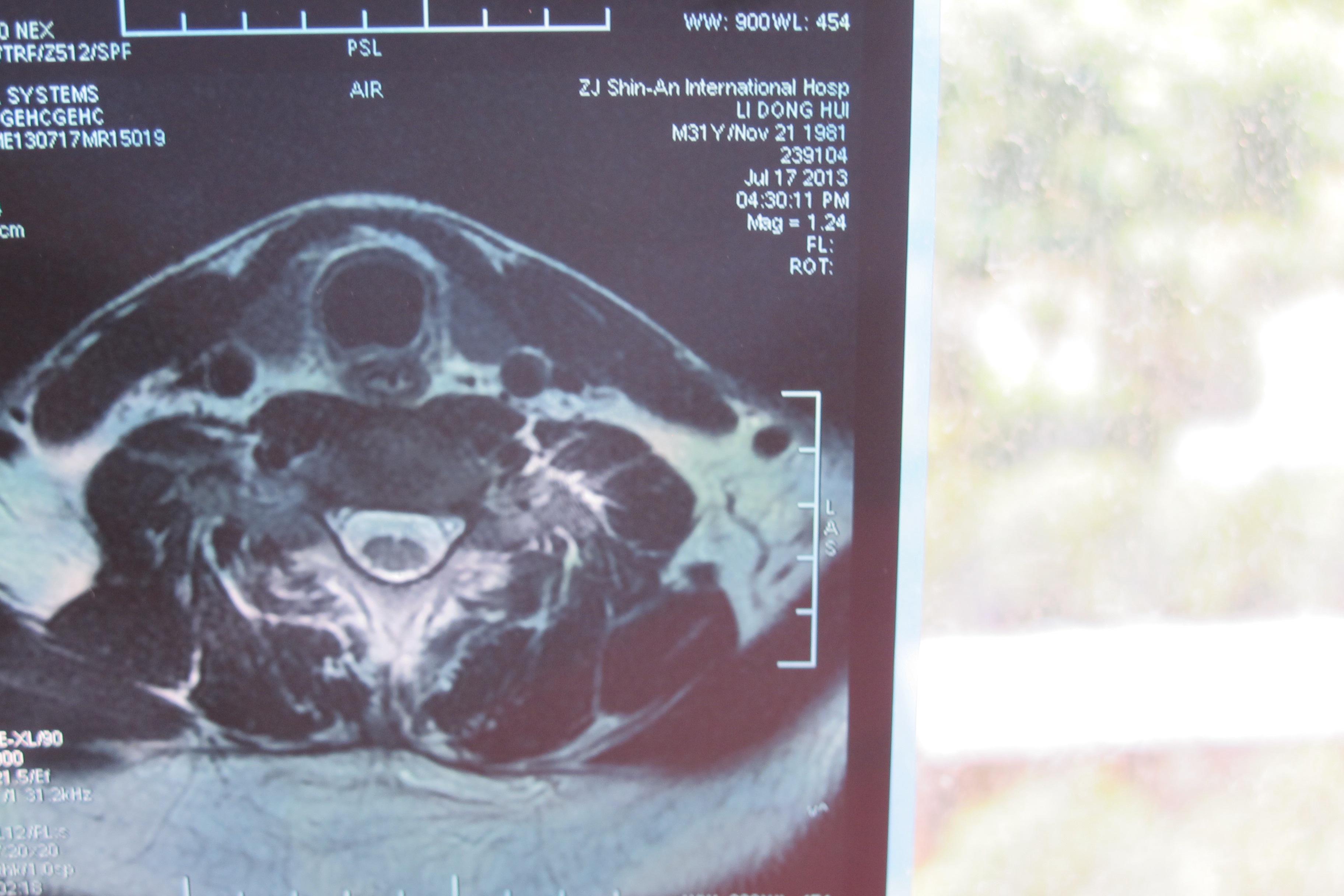 颈椎间盘轻度突出