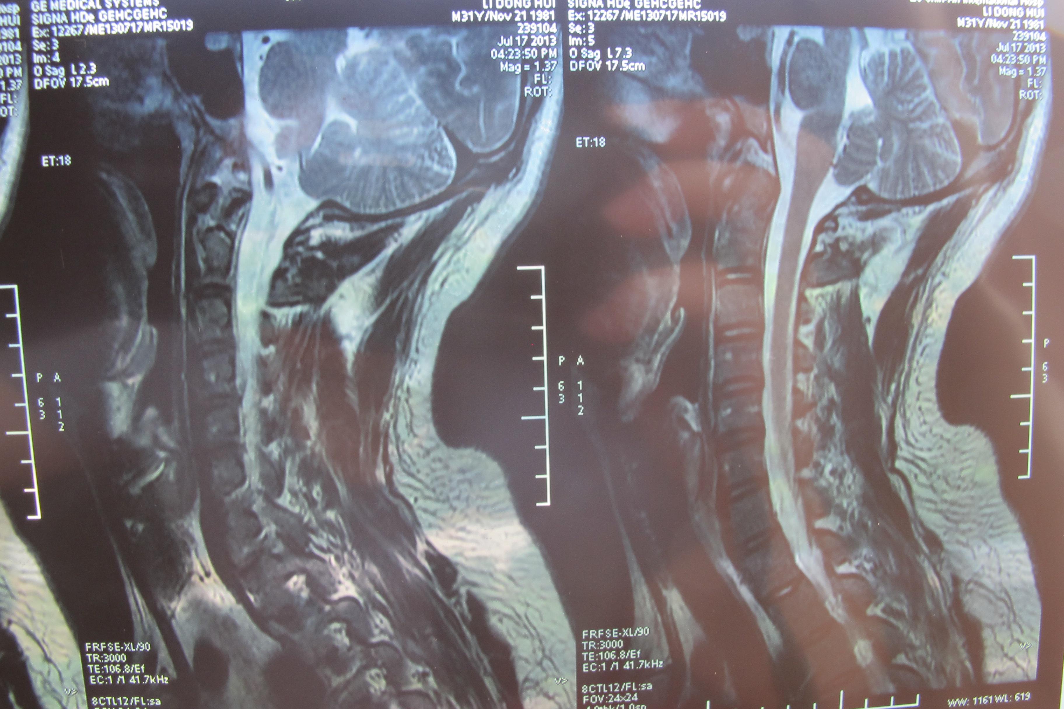 颈椎间盘轻度突出