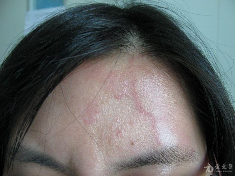 面部红斑远心性环状红斑