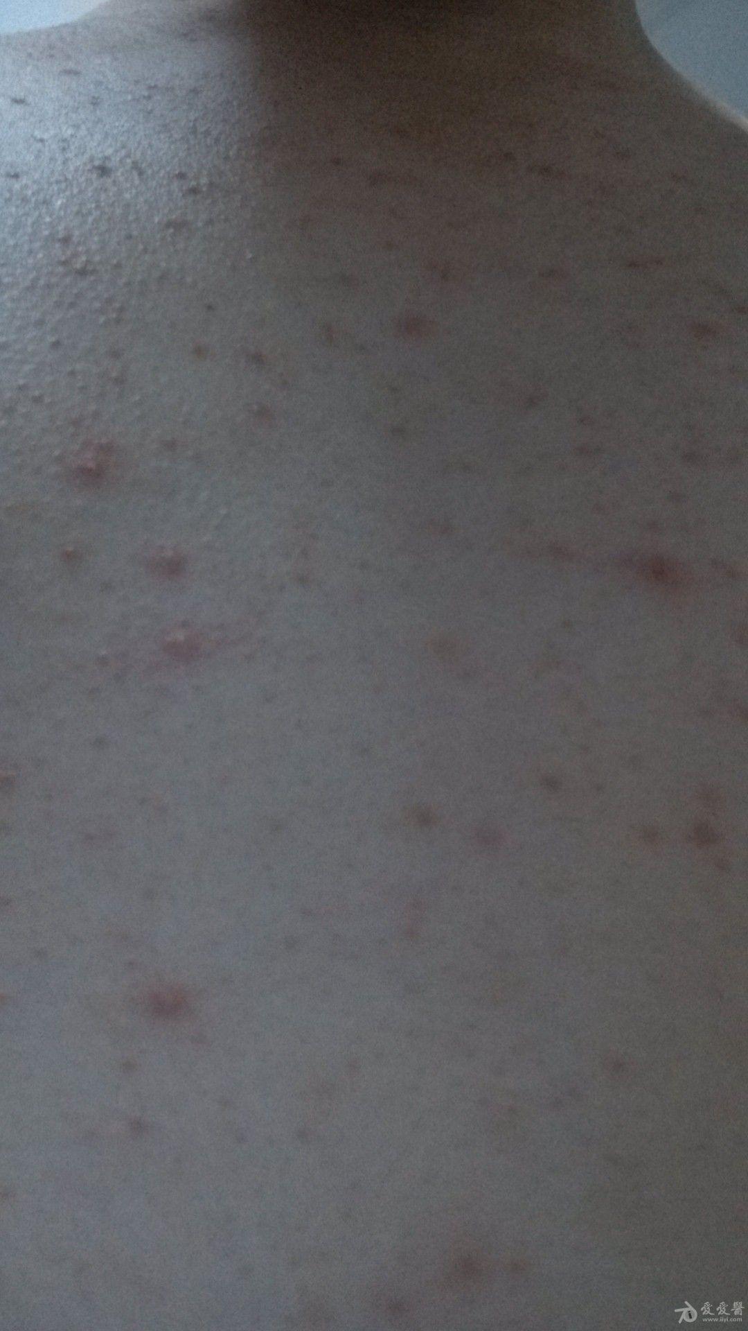 看下这个是糠皮孢子菌麽