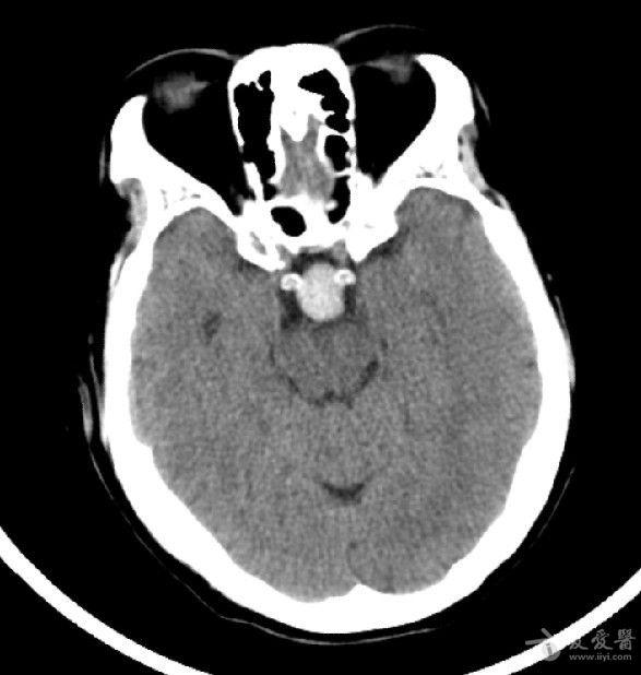 病例30:rathke囊肿