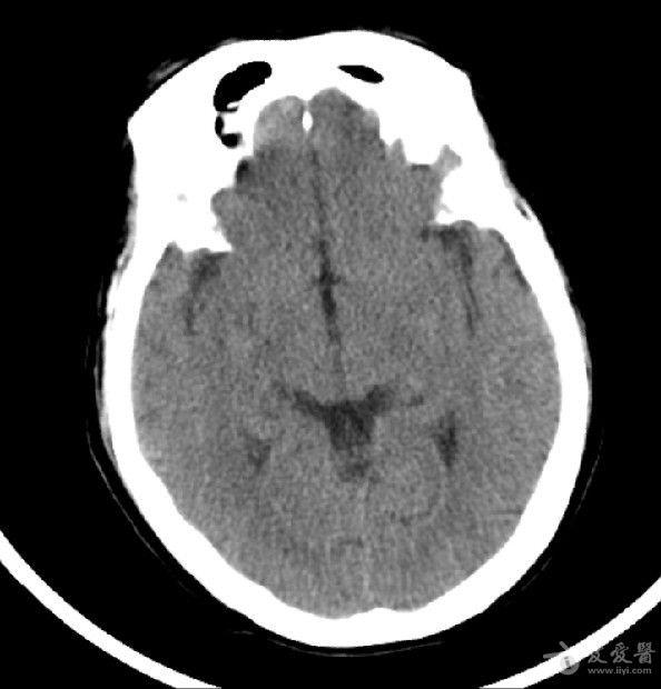 病例30:rathke囊肿