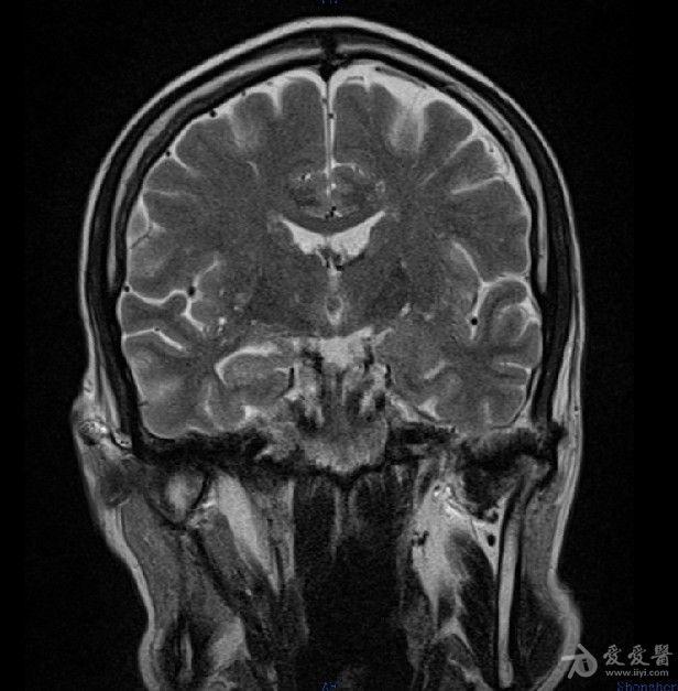 病例30:rathke囊肿