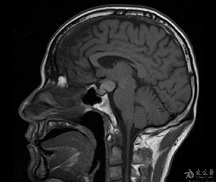 病例30rathke囊肿