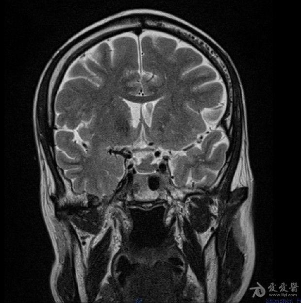 病例30:rathke囊肿