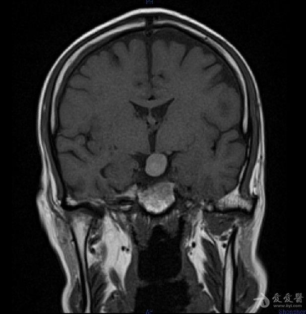 病例30:rathke囊肿