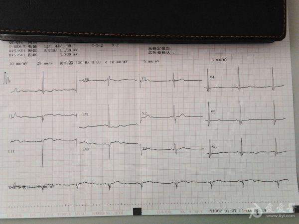 这个V4-V6的Q波异常吗？
