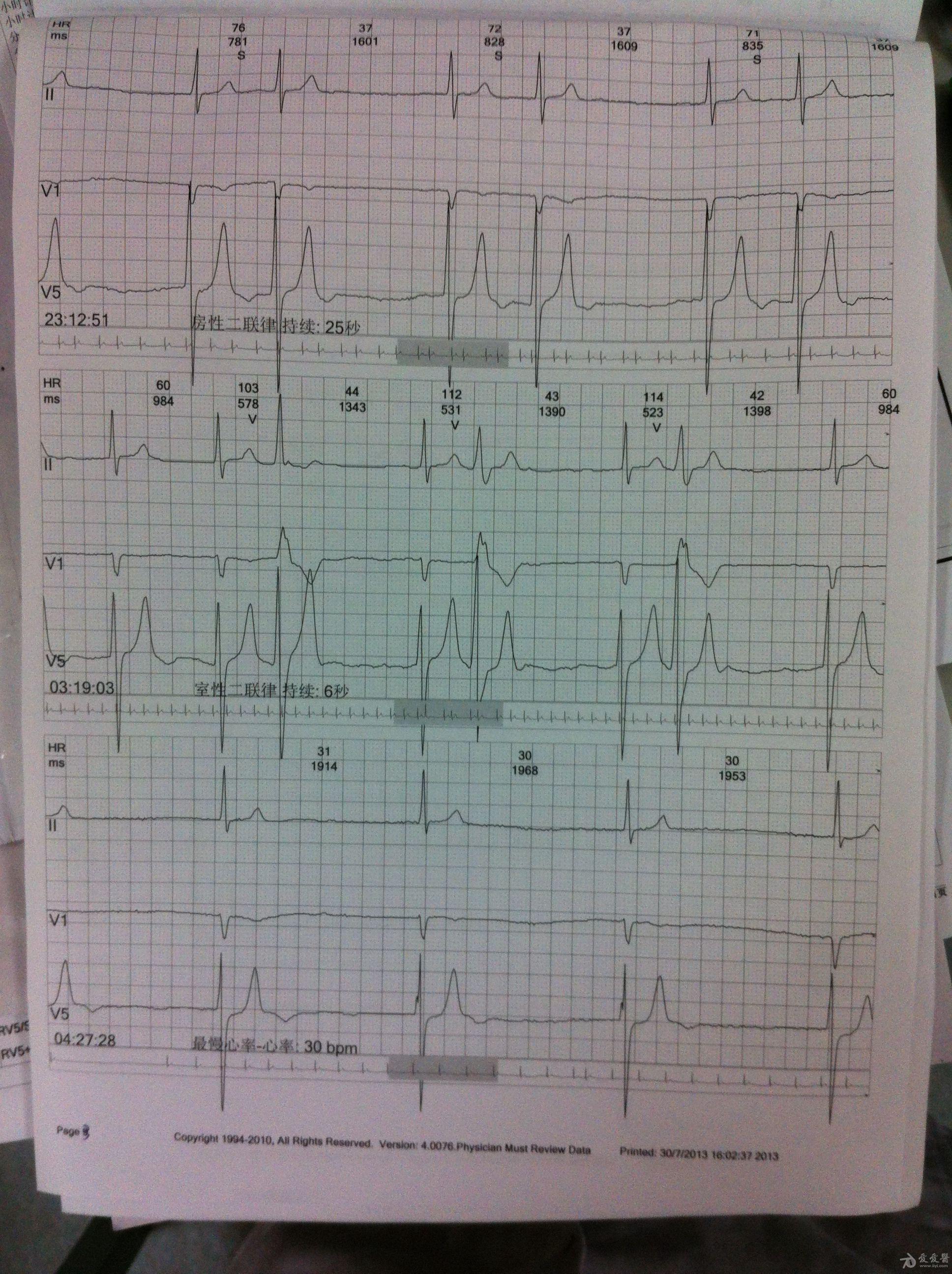 请老师们看看,房颤还是加速{banned}界性逸搏心律