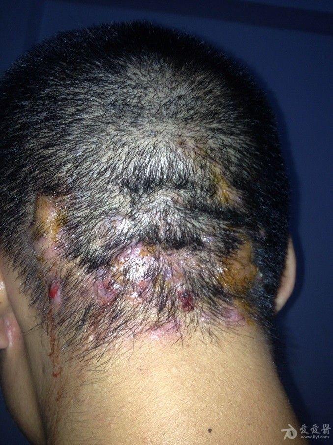 求治疗办法毛囊闭锁三联症