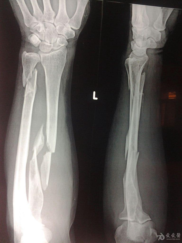 手臂骨折x光片图片