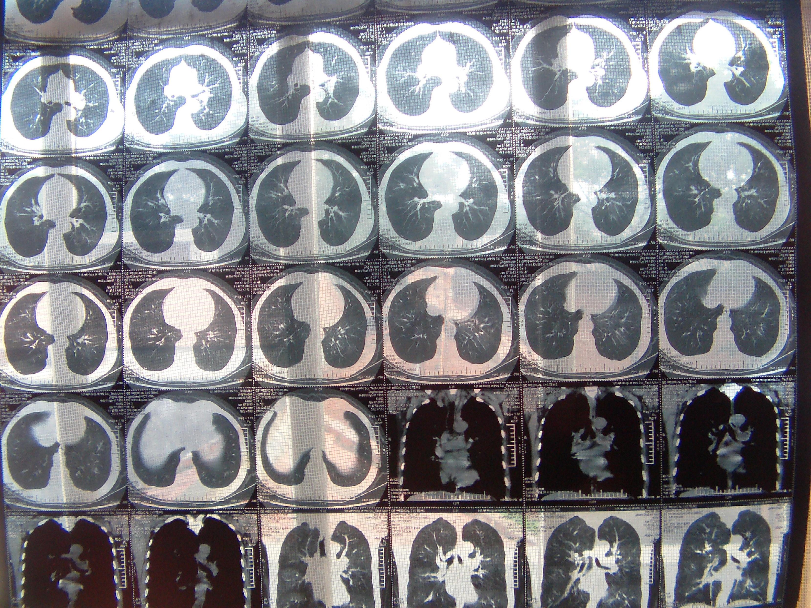 求专家看看这例病人 ct