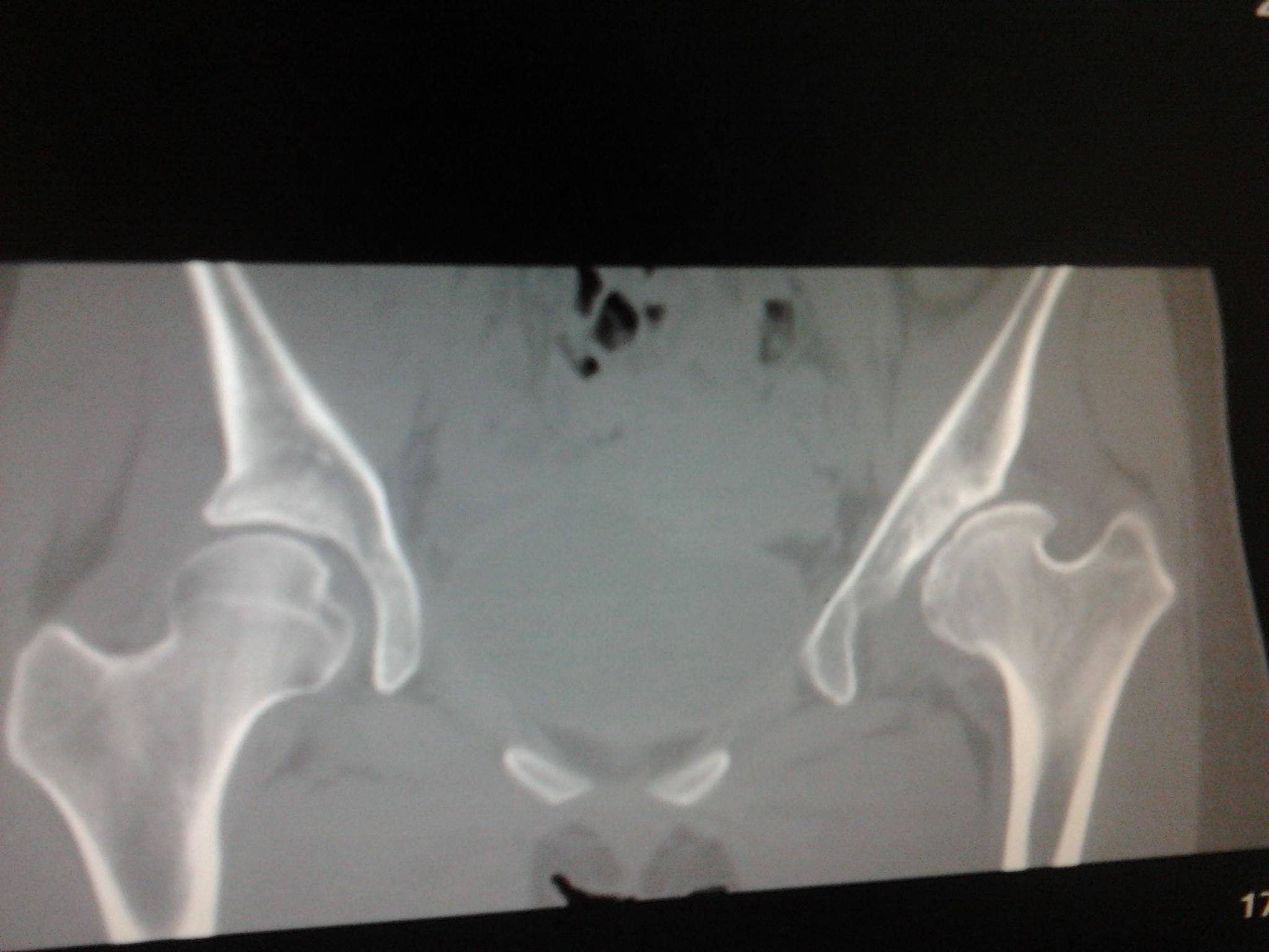 先天性髋关节半脱位并发育不良