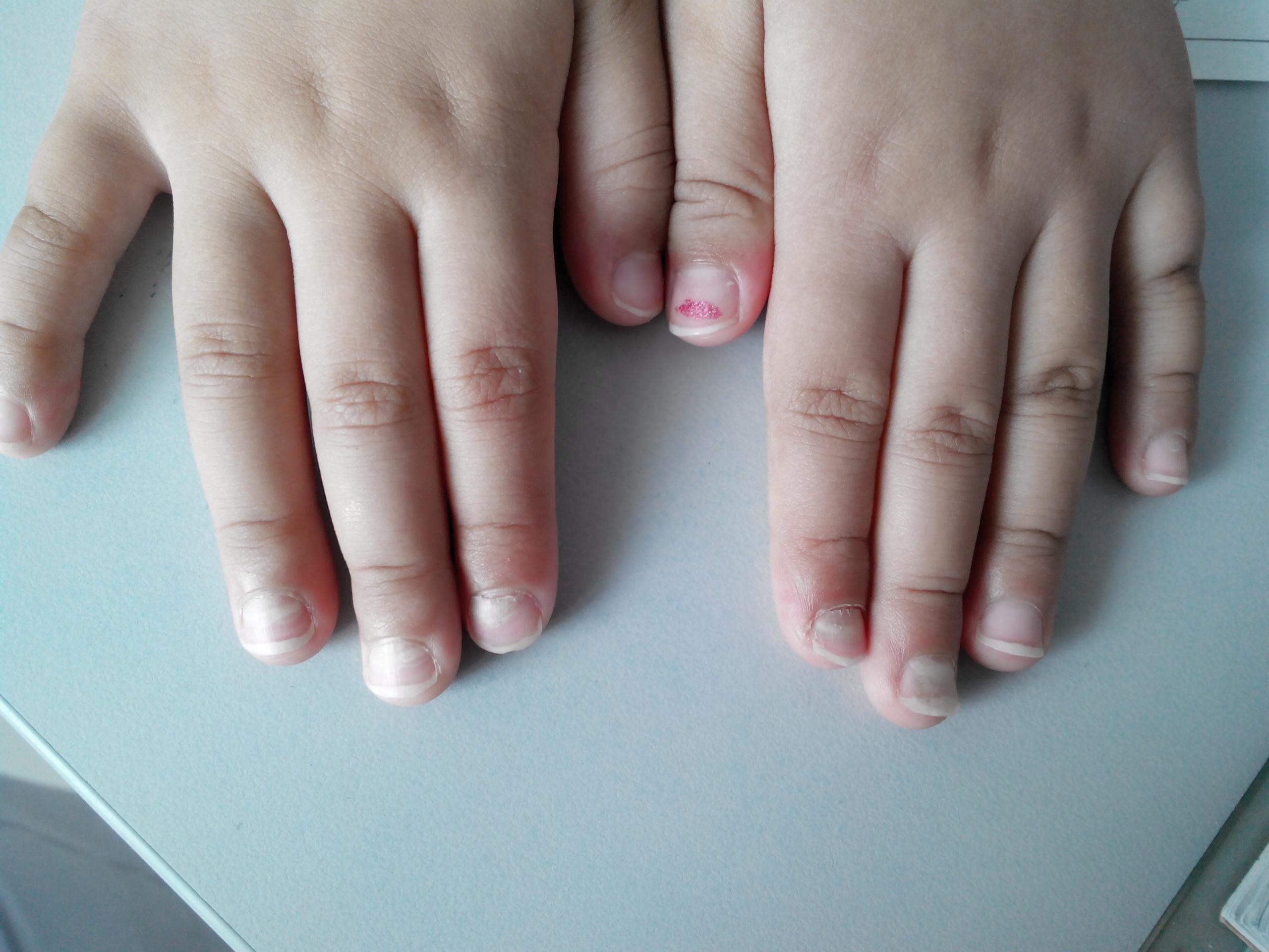 是不是甲营养不良