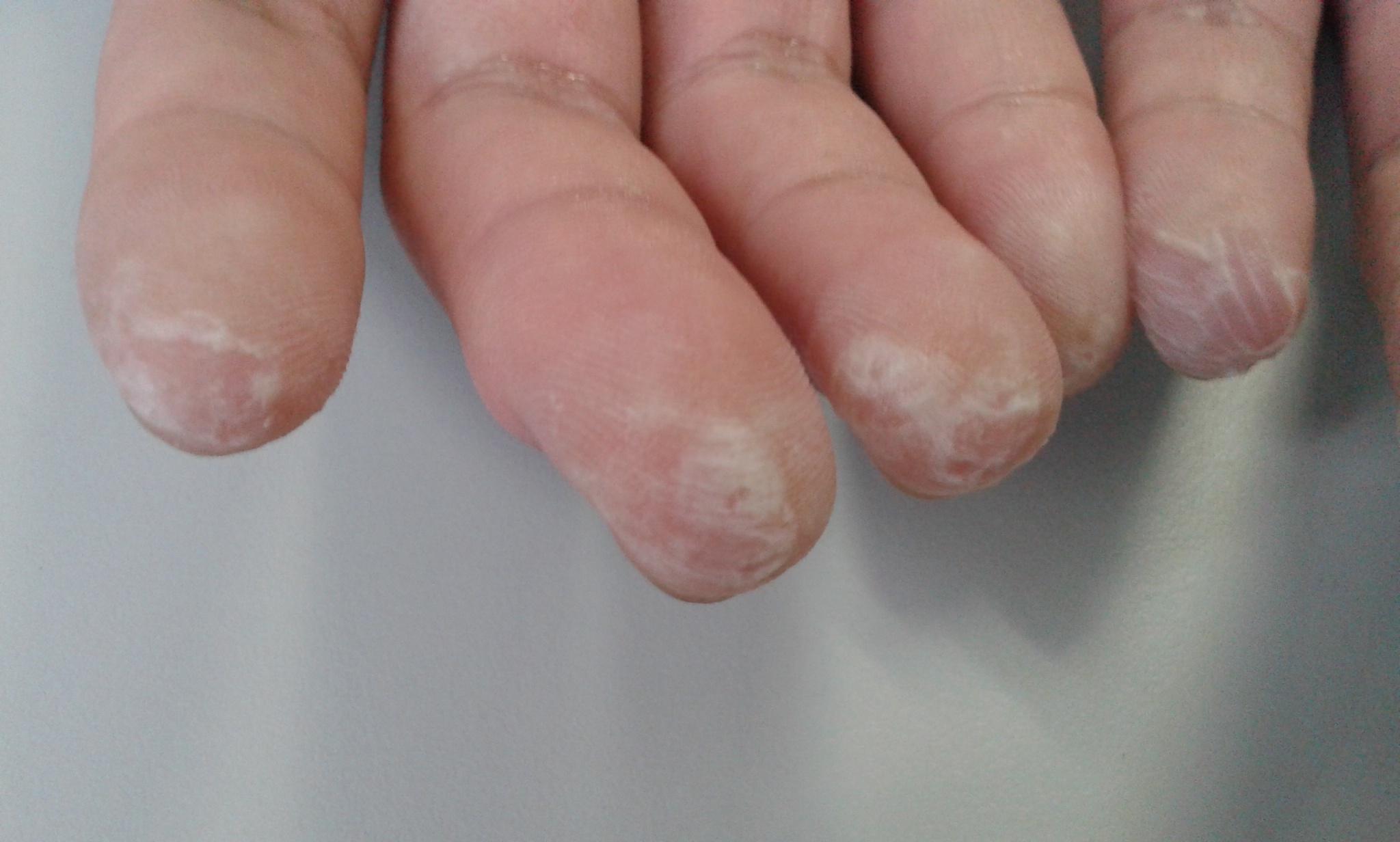 水源性肢端角化