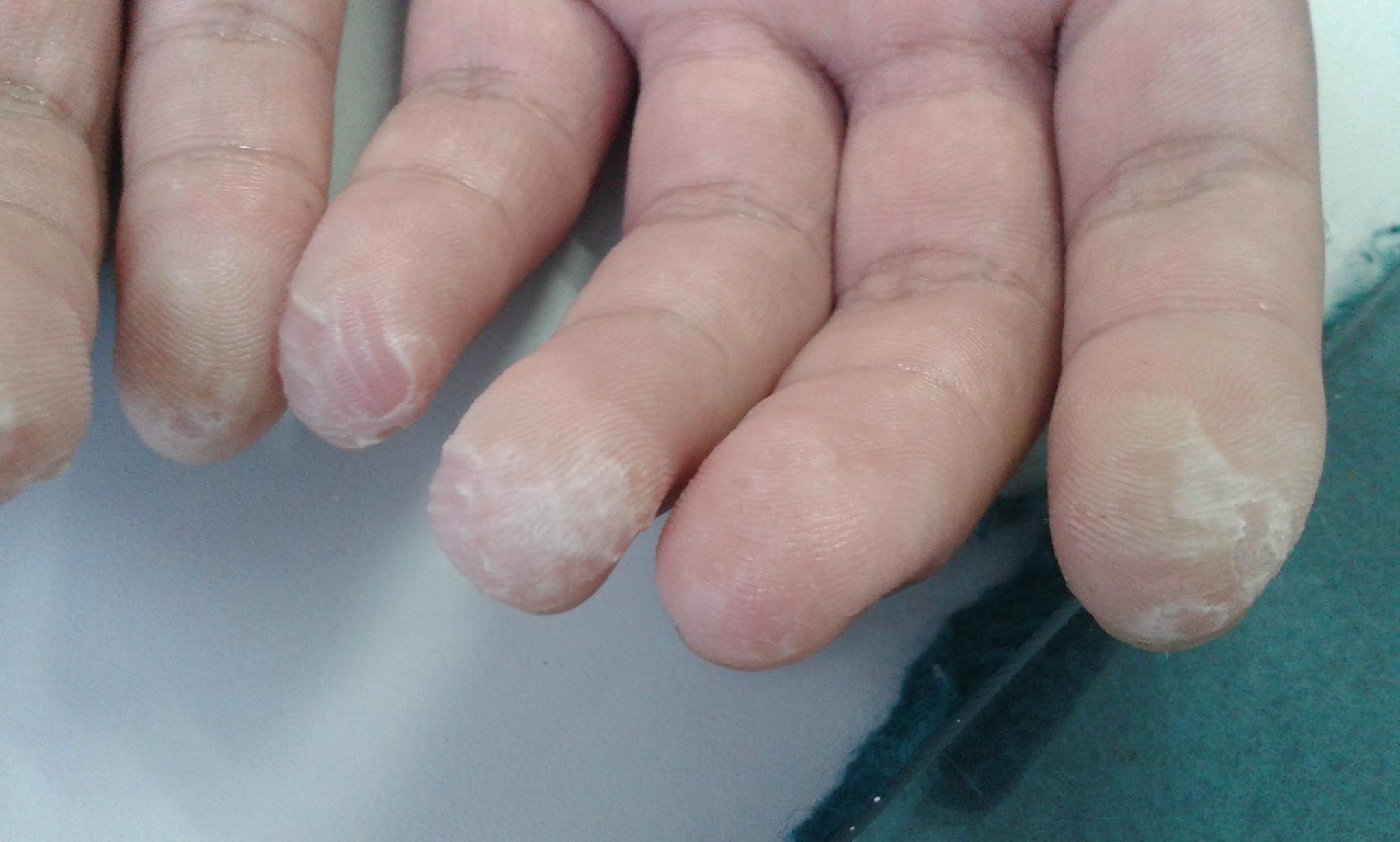 水源性肢端角化