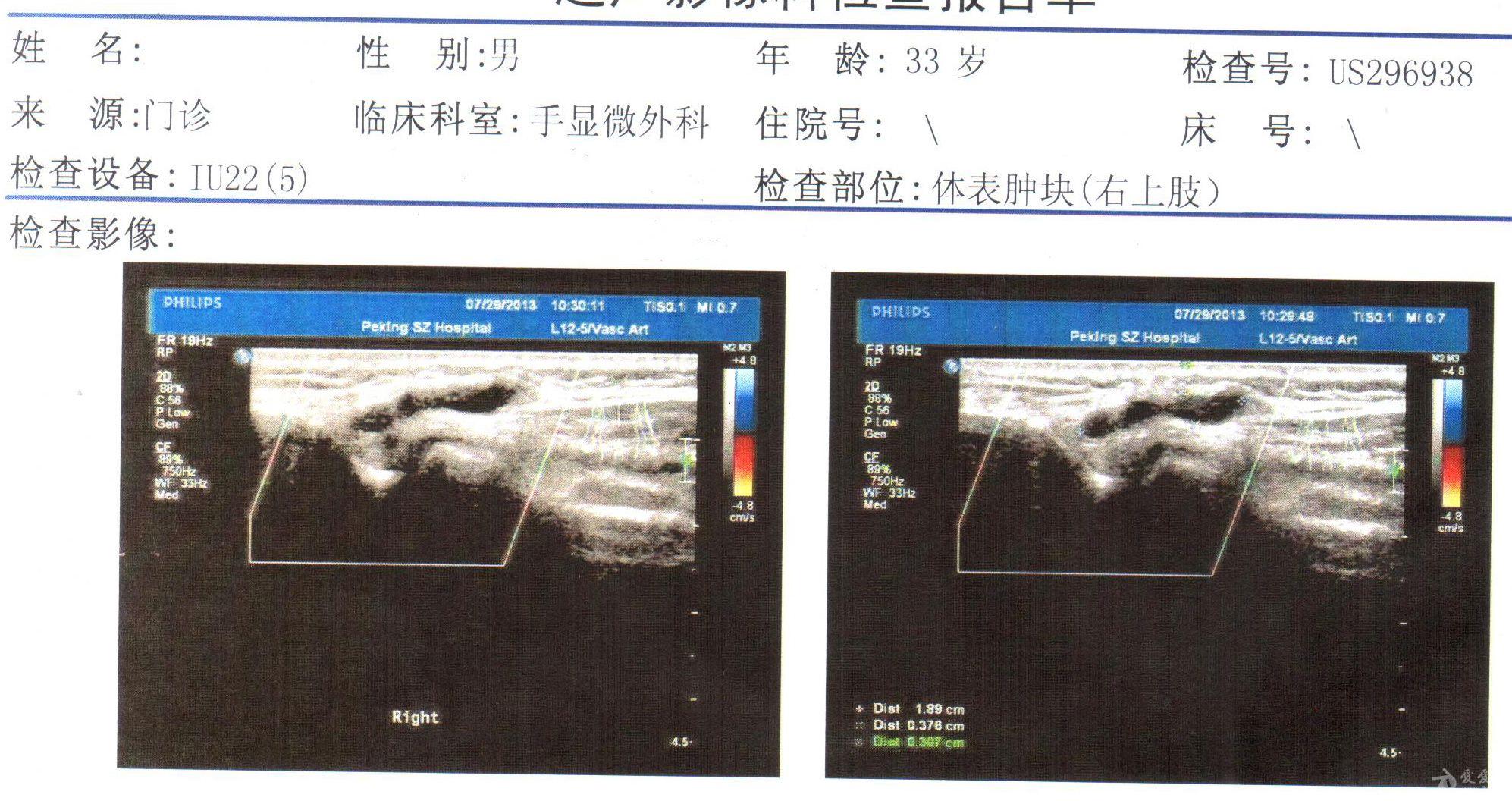 右肘关节外侧体表肿块 超声医学讨论版 爱爱医医学论坛