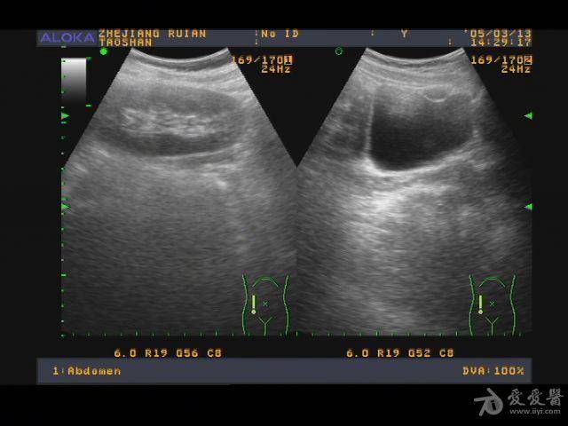 膀胱囊肿超声图片图片