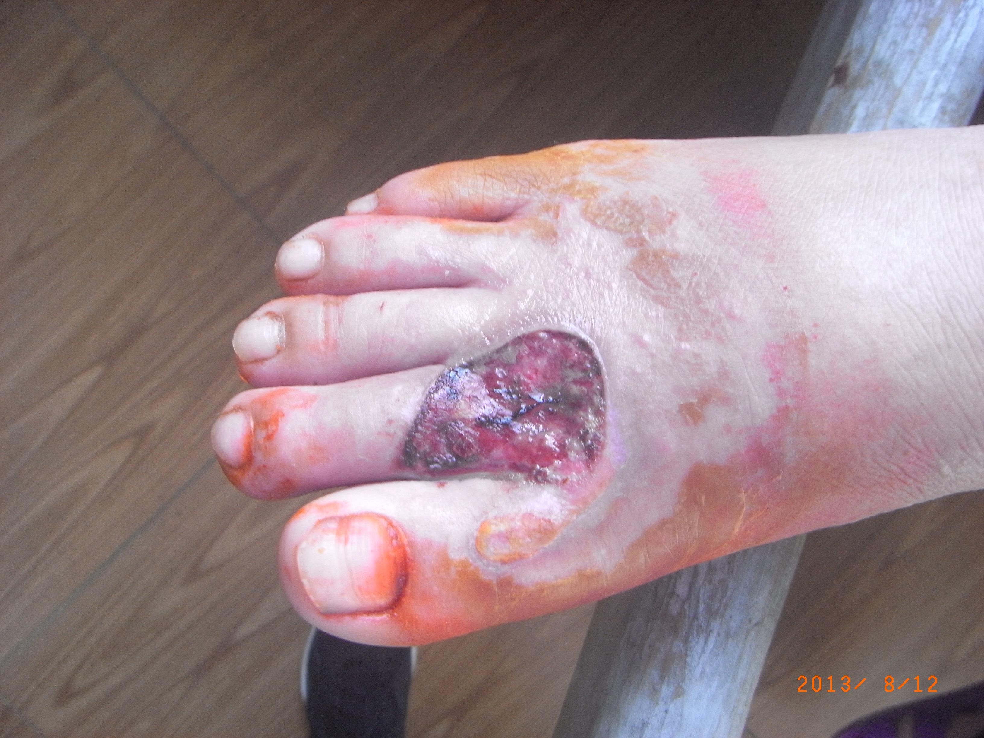 左脚背远端皮肤挫裂伤伴感染