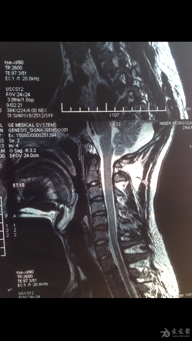 颈椎磁共振正常图片