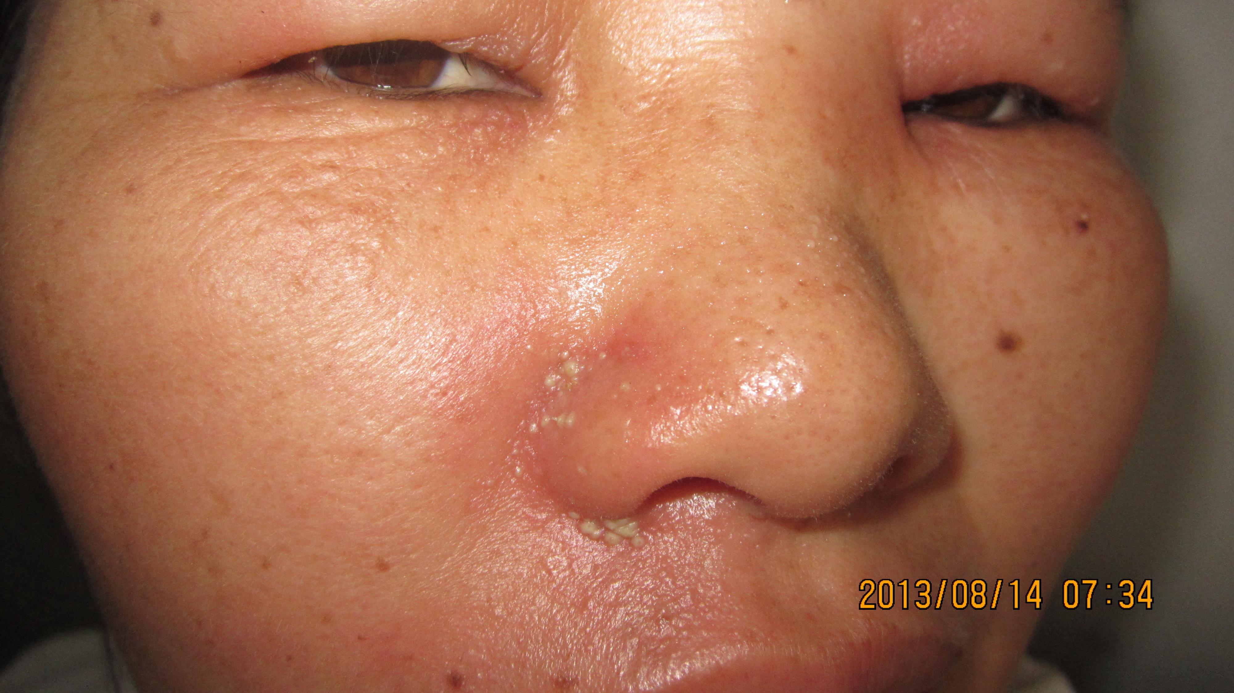 有奖竞猜一隐翅虫皮炎