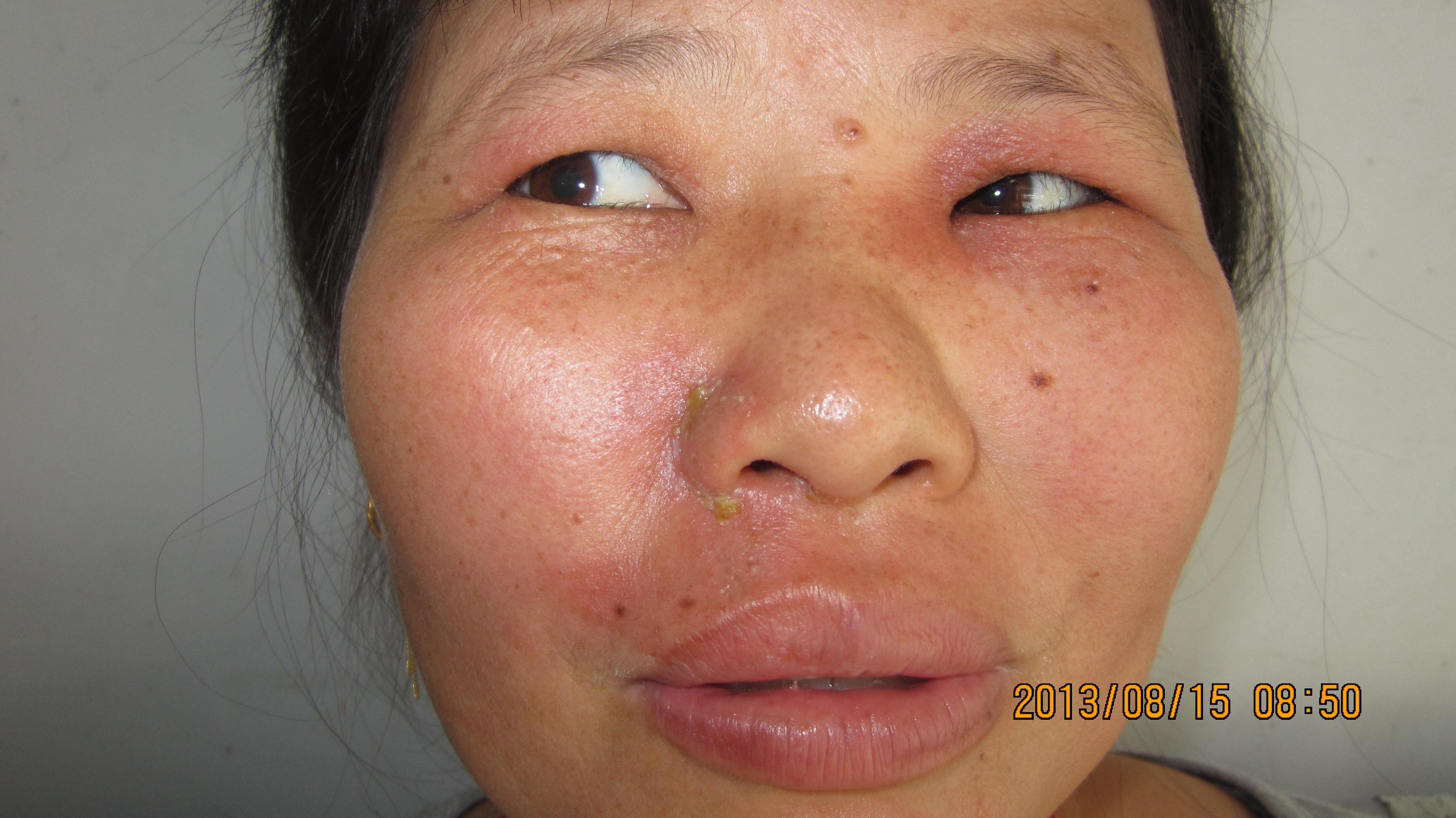 有奖竞猜一 隐翅虫皮炎