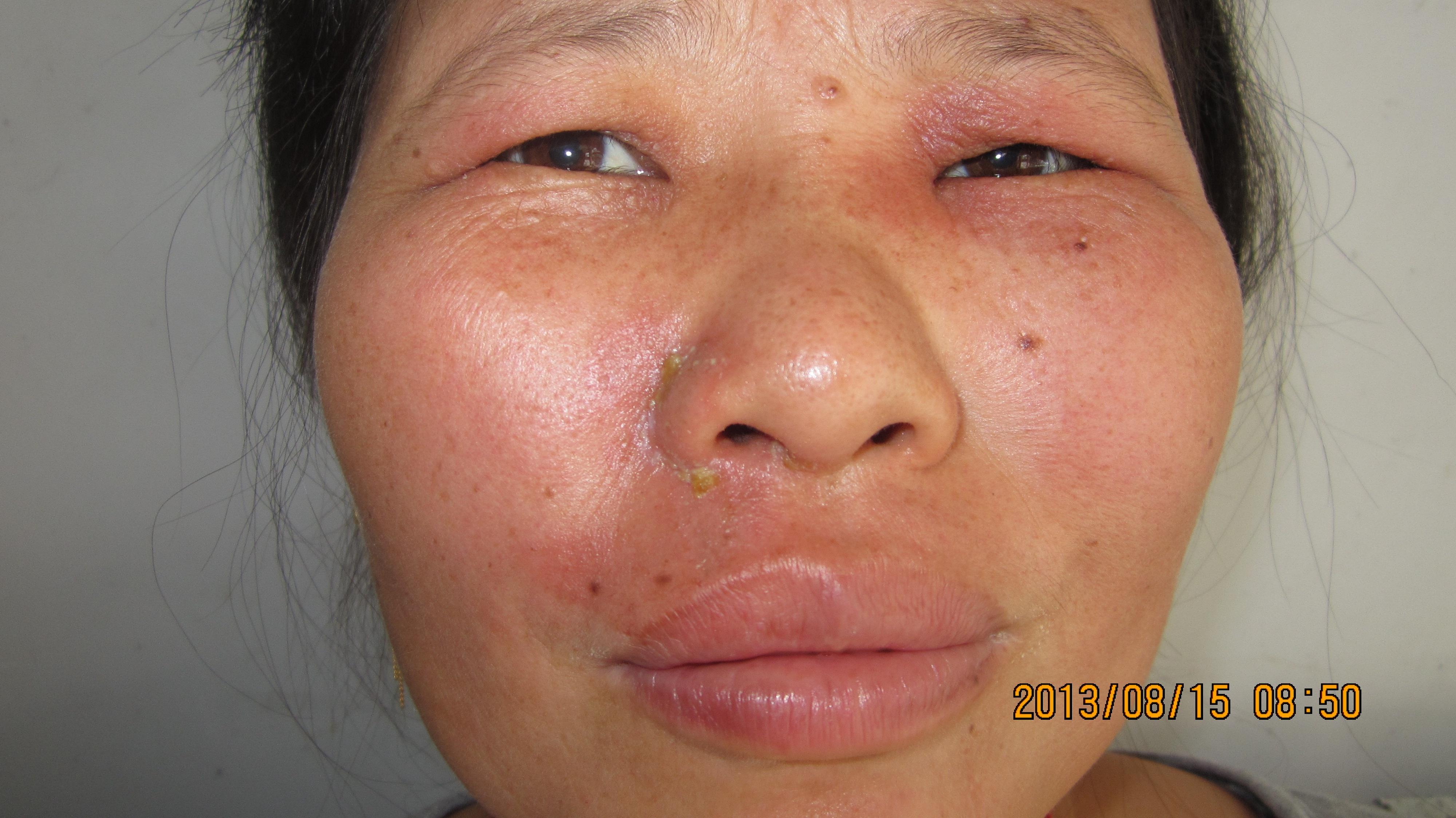 有奖竞猜一 隐翅虫皮炎