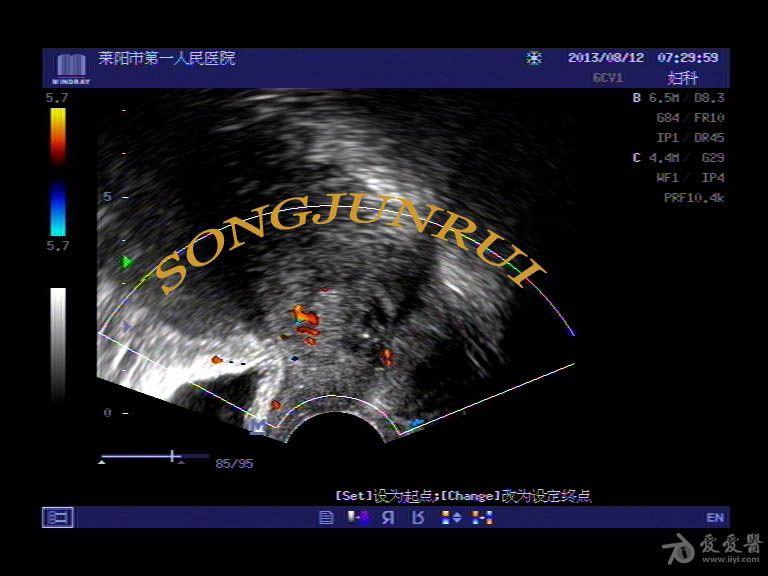 超声入门贴129宫颈癌超声病理图