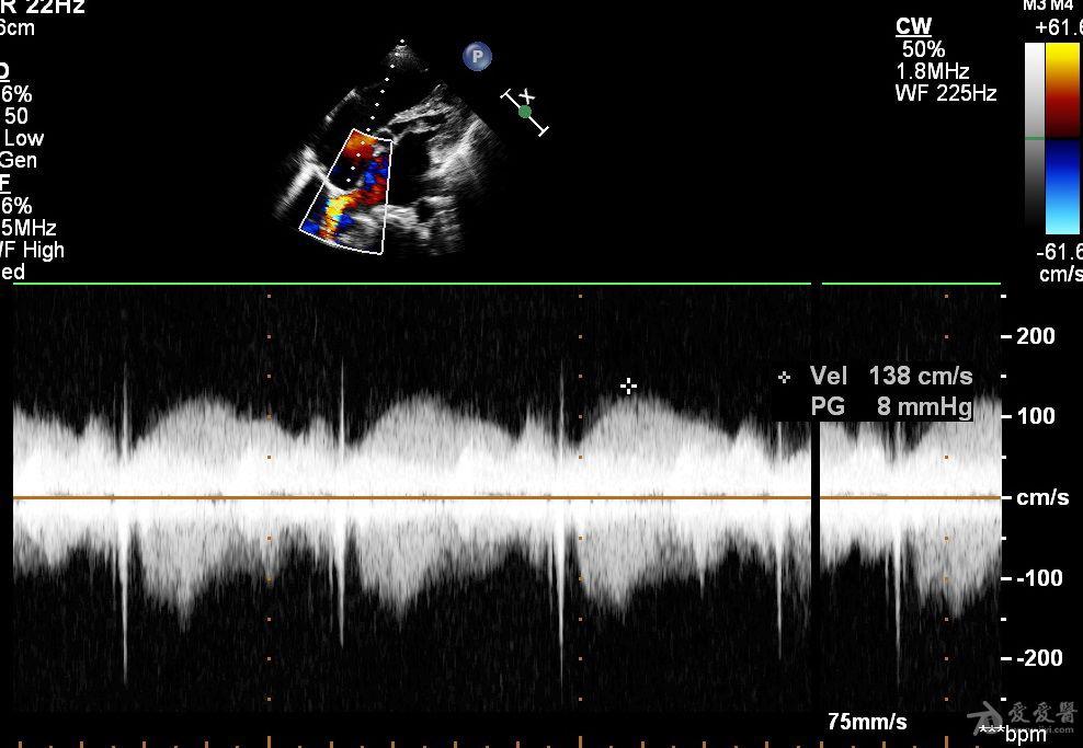 肺静脉频谱图解析图片