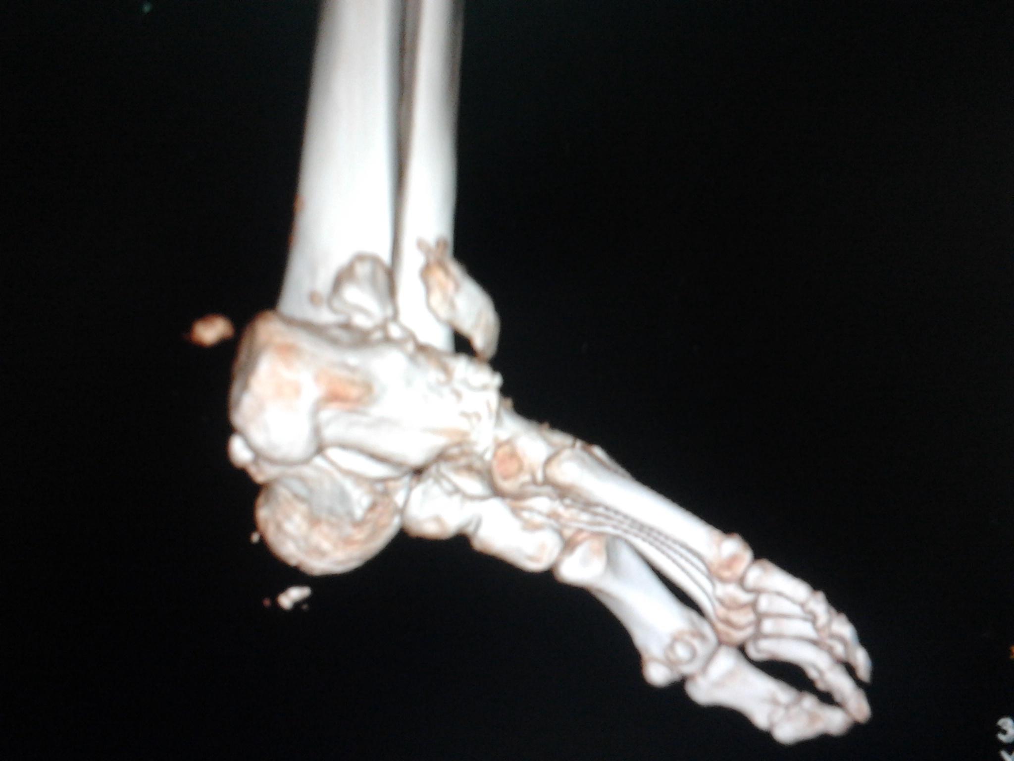 右踝关节距跟关节脱位