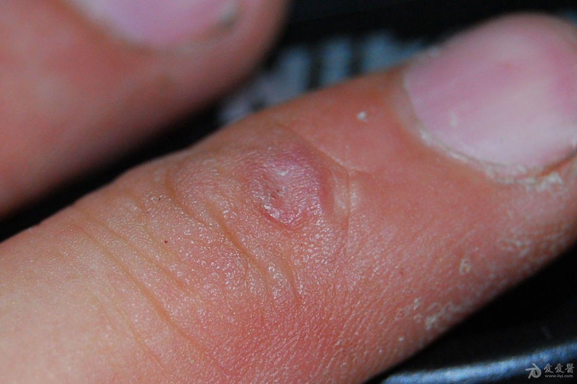 手指滑膜肉瘤图片图片