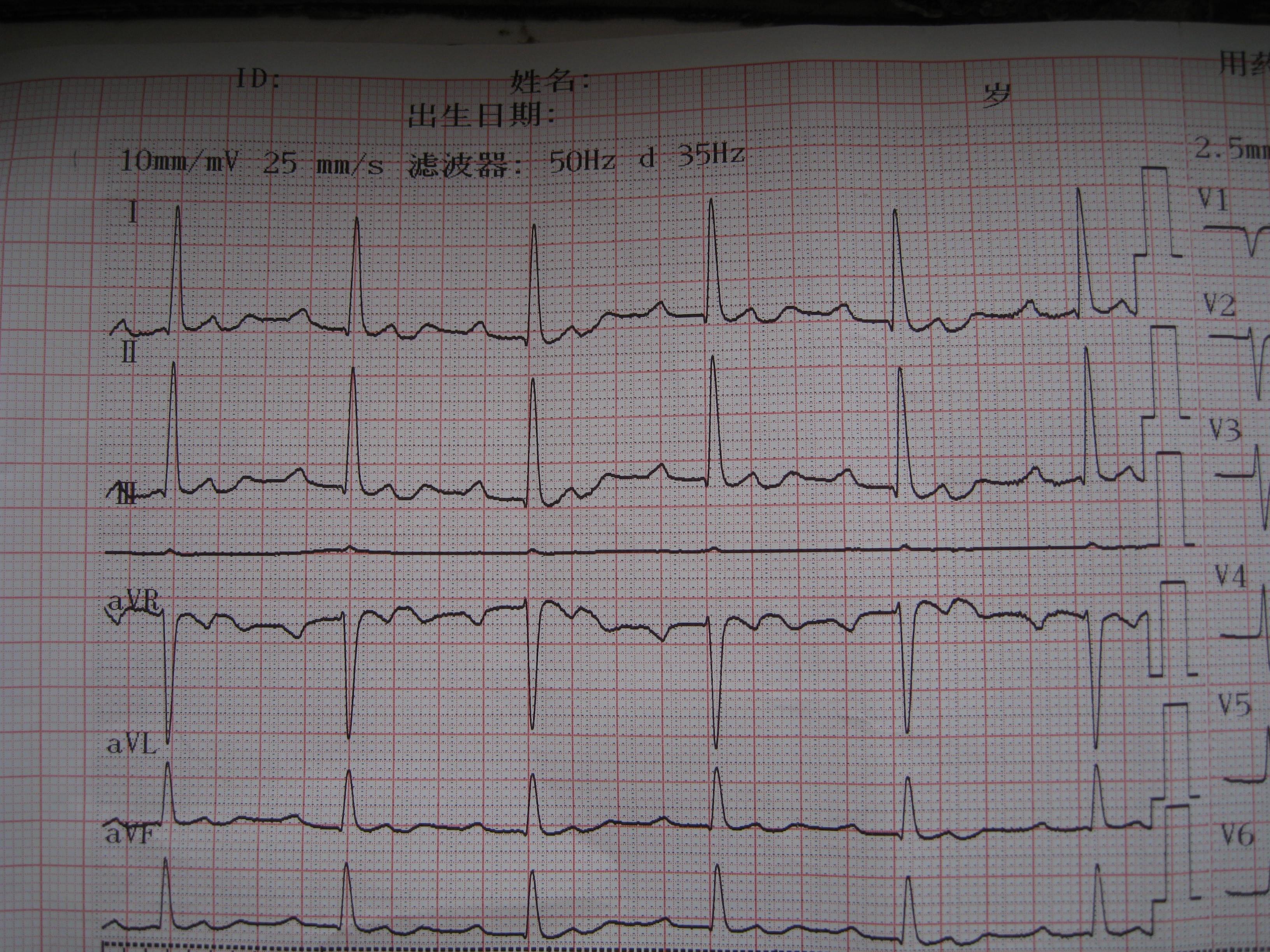 用异丙肾上腺素后心电图