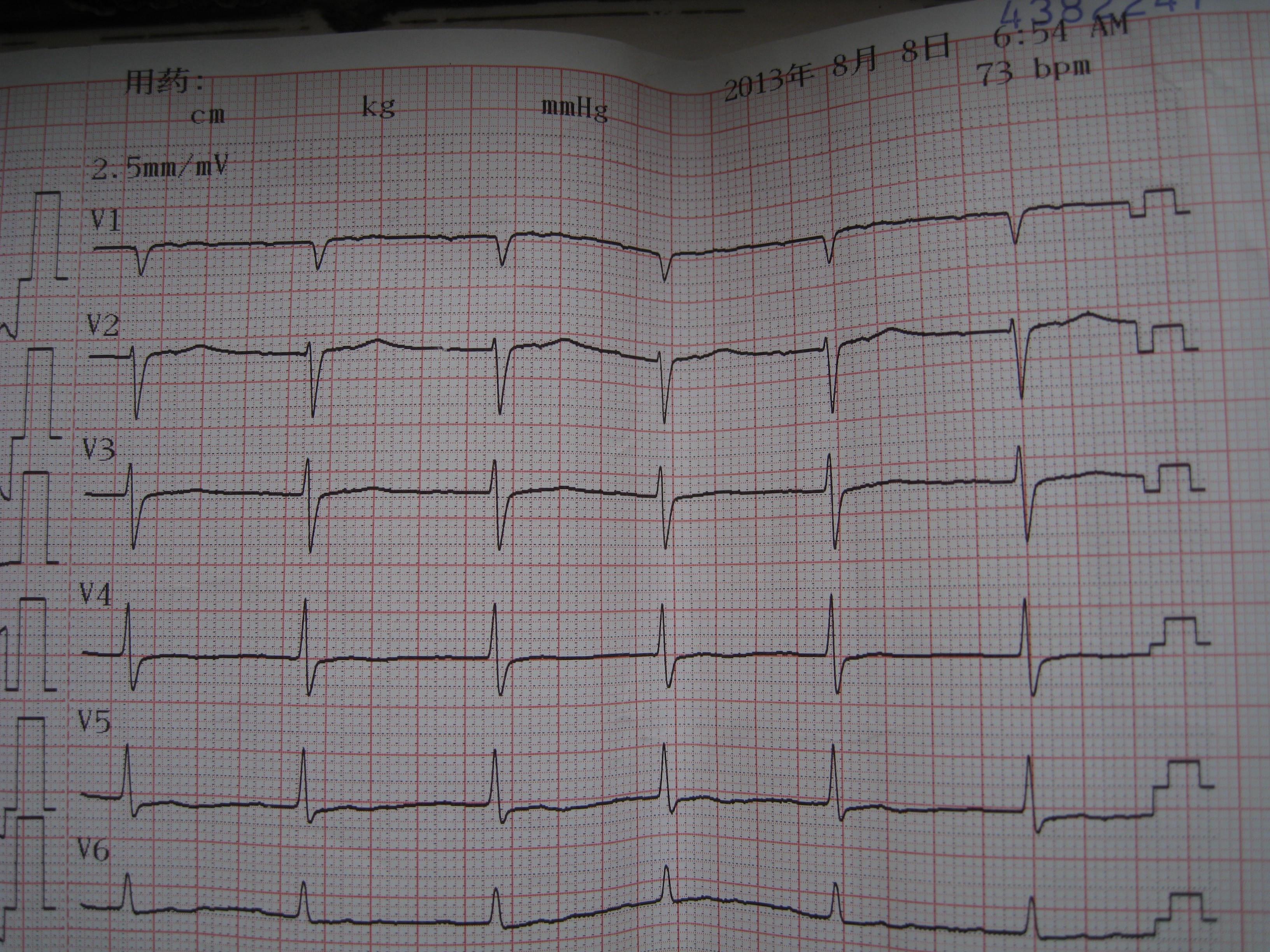 晕厥病例讨论 - 心电图脑电图专业讨论版 - 爱爱医医学论坛