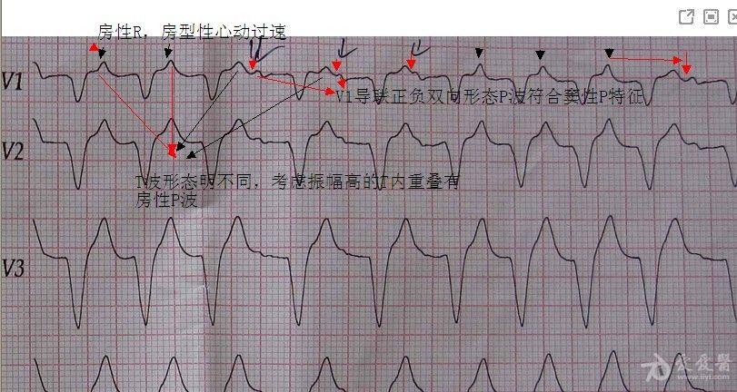 肺源性心脏病人的心电图病人已抢救无效