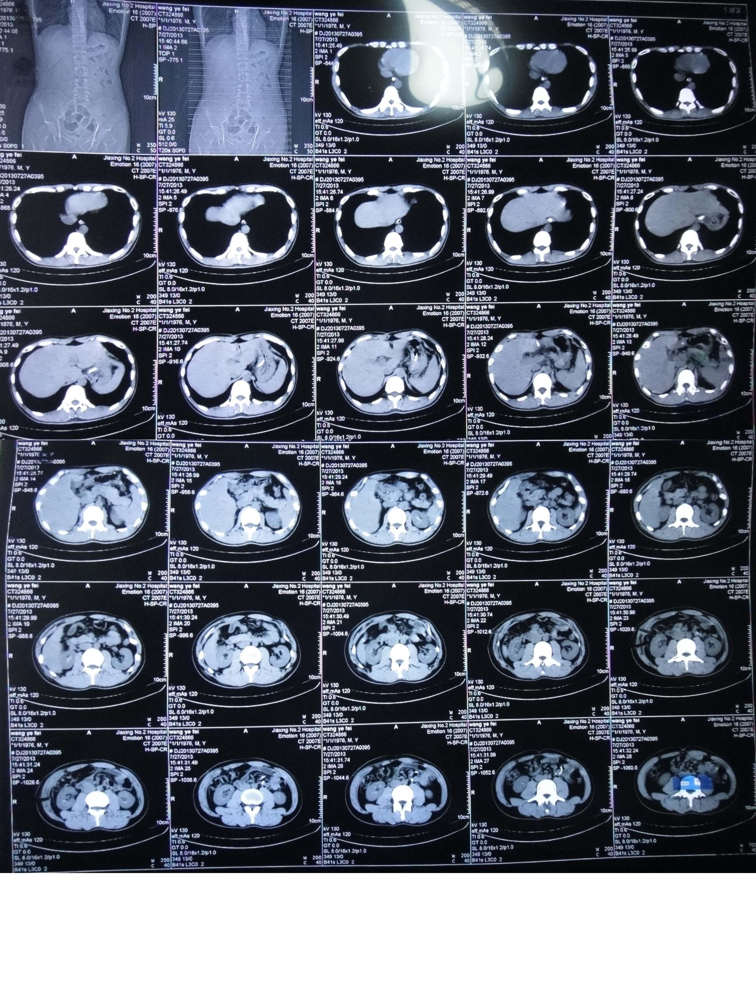 胆总管囊肿术后胆漏已2月有余手术还是持断观察