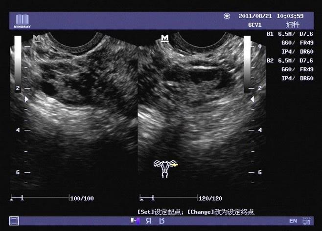 不全縱隔子宮早孕期與非孕期的超聲圖