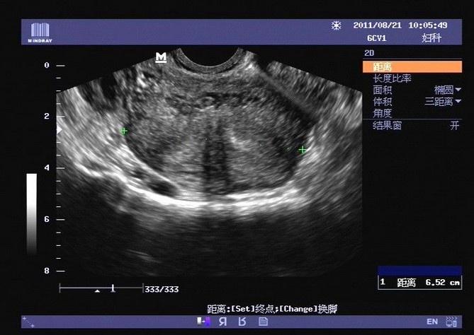 不全纵隔子宫早孕期与非孕期的超声图