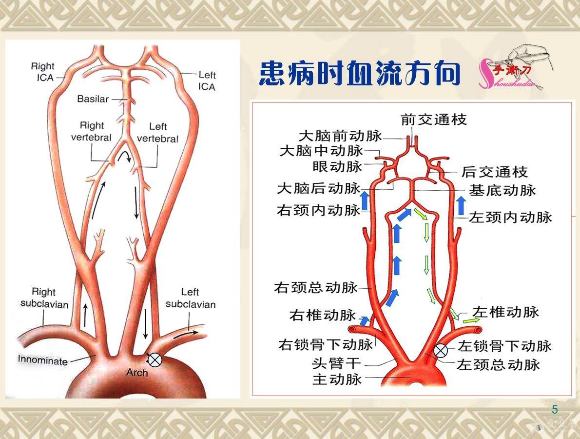 乳内动脉窃血图片