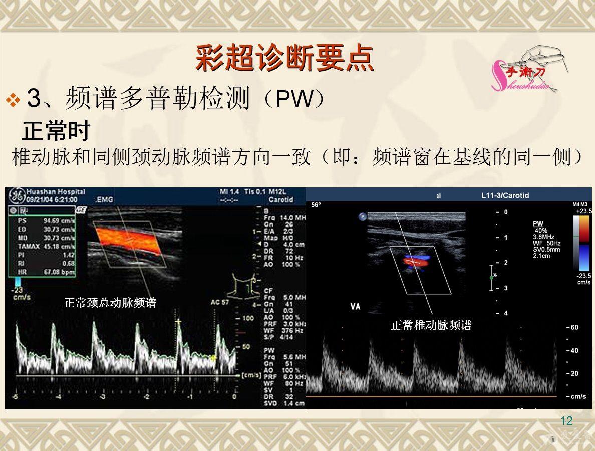 锁骨下动脉超声图片