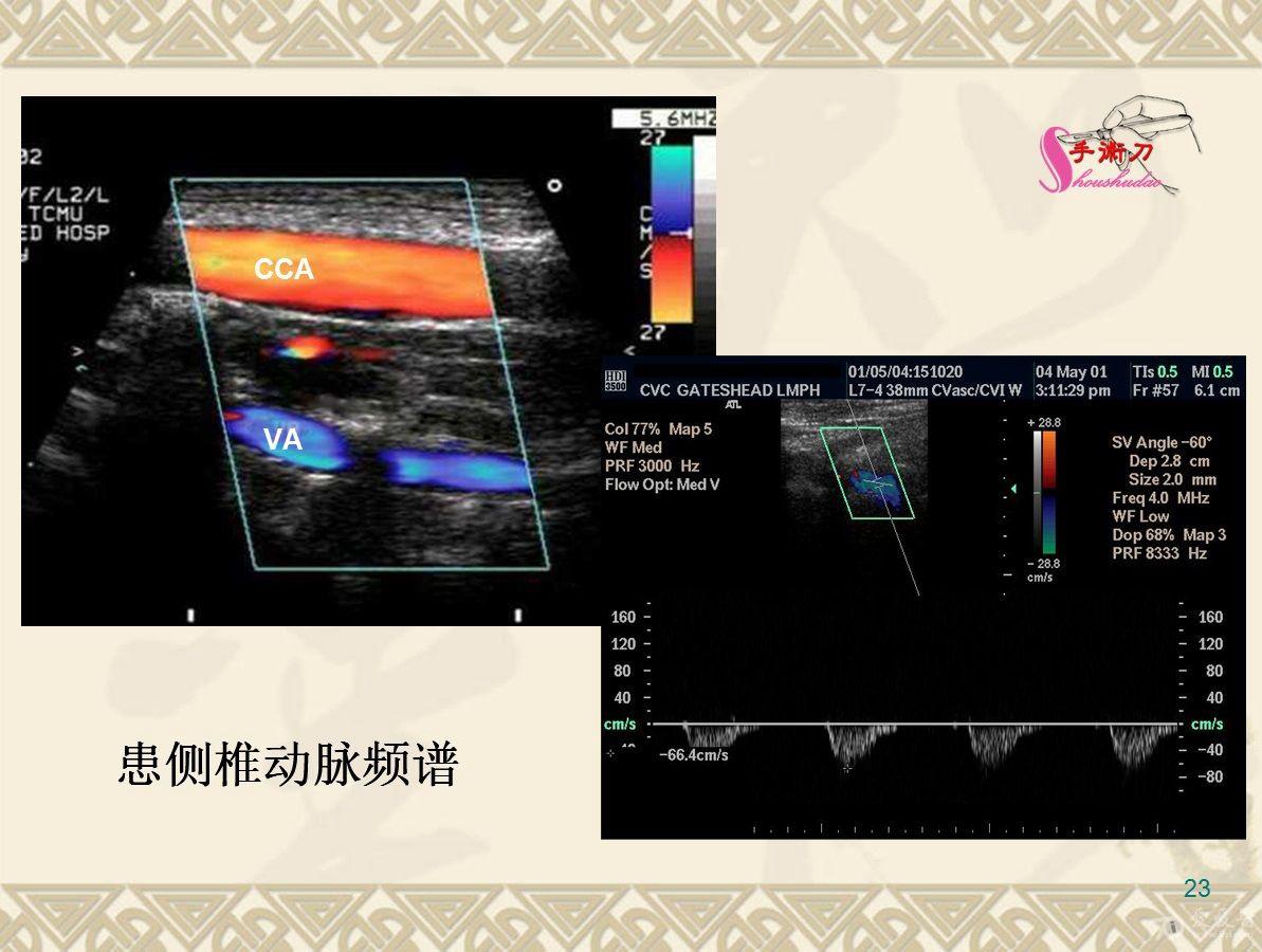 锁骨下动脉超声图片